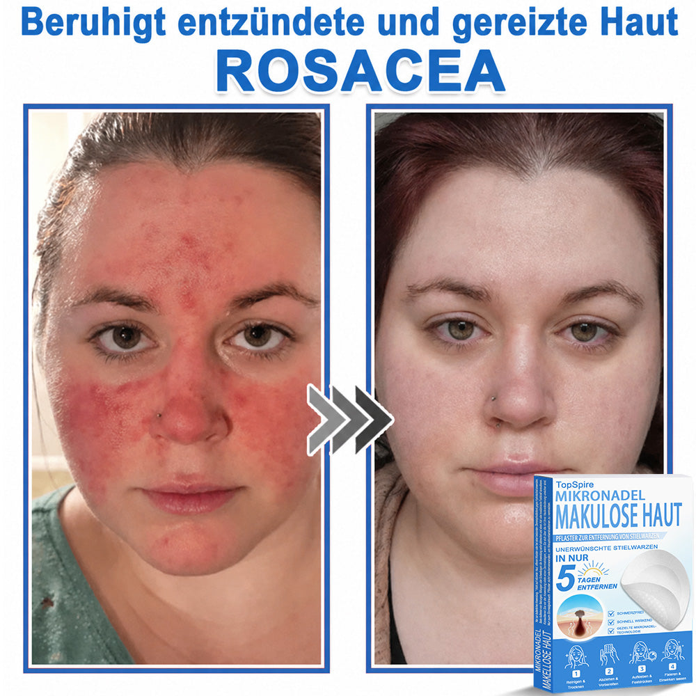 🏆𝑻𝒐𝒑𝑺𝒑𝒊𝒓𝒆® 2-in-1 Mikronadel- & Hydrokolloid-Pflaster | Entferner für erhabene Muttermale, Akne, flache Warzen & Hautanhängsel | Verbessert Falten, Narben & Hautunreinheiten | Unsichtbare Stern-Pickelpflaster für Gesicht & Körper