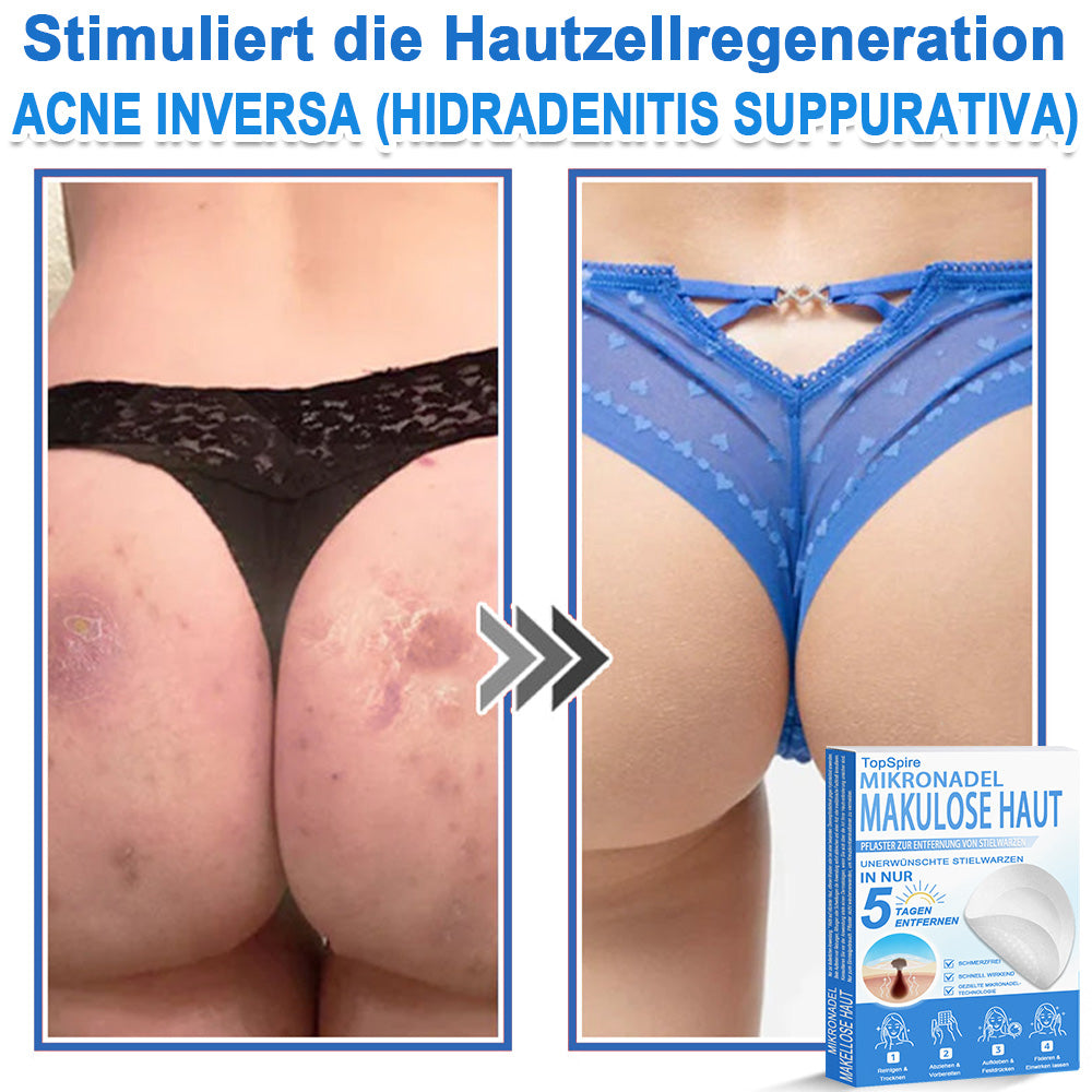 🏆𝑻𝒐𝒑𝑺𝒑𝒊𝒓𝒆® 2-in-1 Mikronadel- & Hydrokolloid-Pflaster | Entferner für erhabene Muttermale, Akne, flache Warzen & Hautanhängsel | Verbessert Falten, Narben & Hautunreinheiten | Unsichtbare Stern-Pickelpflaster für Gesicht & Körper
