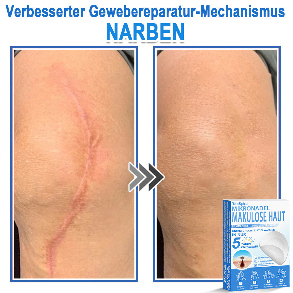 🏆𝑻𝒐𝒑𝑺𝒑𝒊𝒓𝒆® 2-in-1 Mikronadel- & Hydrokolloid-Pflaster | Entferner für erhabene Muttermale, Akne, flache Warzen & Hautanhängsel | Verbessert Falten, Narben & Hautunreinheiten | Unsichtbare Stern-Pickelpflaster für Gesicht & Körper