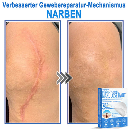 🏆𝑻𝒐𝒑𝑺𝒑𝒊𝒓𝒆® 2-in-1 Mikronadel- & Hydrokolloid-Pflaster | Entferner für erhabene Muttermale, Akne, flache Warzen & Hautanhängsel | Verbessert Falten, Narben & Hautunreinheiten | Unsichtbare Stern-Pickelpflaster für Gesicht & Körper