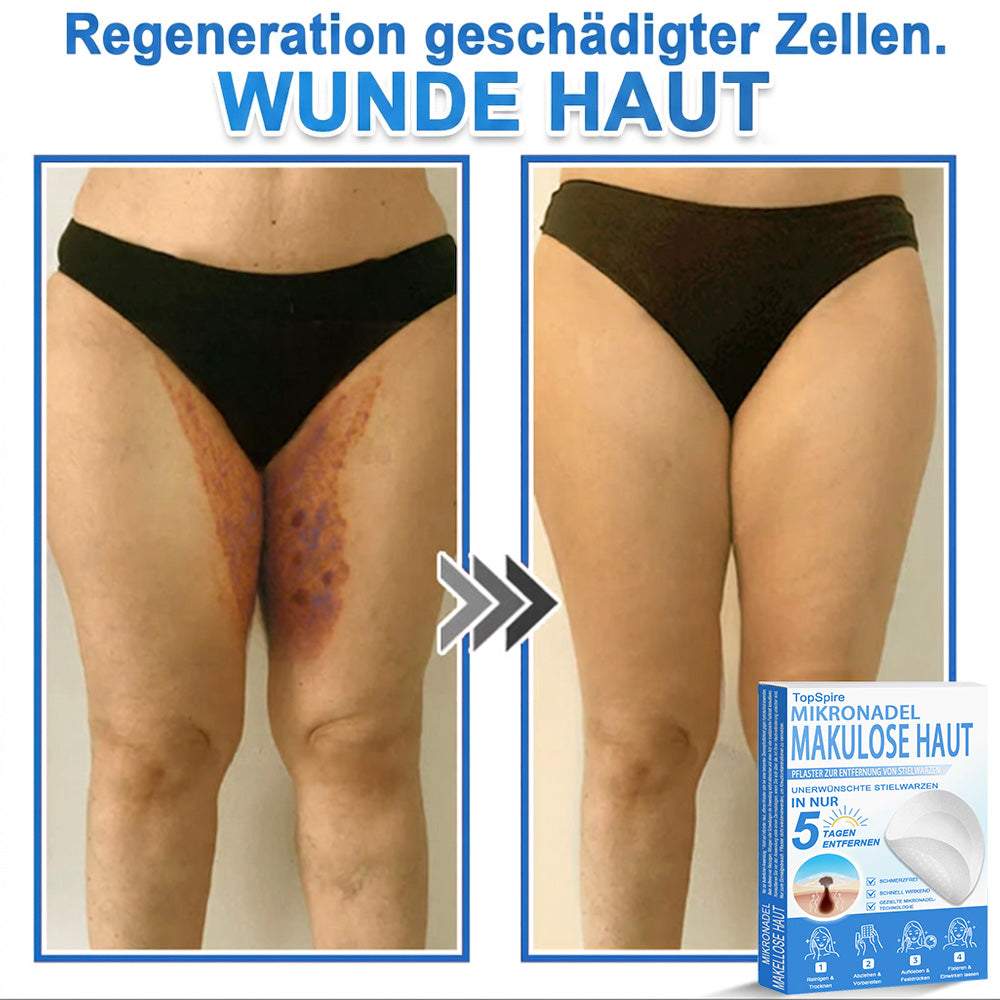 🏆𝑻𝒐𝒑𝑺𝒑𝒊𝒓𝒆® 2-in-1 Mikronadel- & Hydrokolloid-Pflaster | Entferner für erhabene Muttermale, Akne, flache Warzen & Hautanhängsel | Verbessert Falten, Narben & Hautunreinheiten | Unsichtbare Stern-Pickelpflaster für Gesicht & Körper