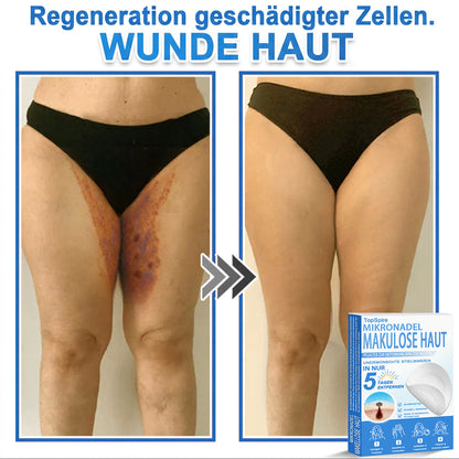 🏆𝑻𝒐𝒑𝑺𝒑𝒊𝒓𝒆® 2-in-1 Mikronadel- & Hydrokolloid-Pflaster | Entferner für erhabene Muttermale, Akne, flache Warzen & Hautanhängsel | Verbessert Falten, Narben & Hautunreinheiten | Unsichtbare Stern-Pickelpflaster für Gesicht & Körper