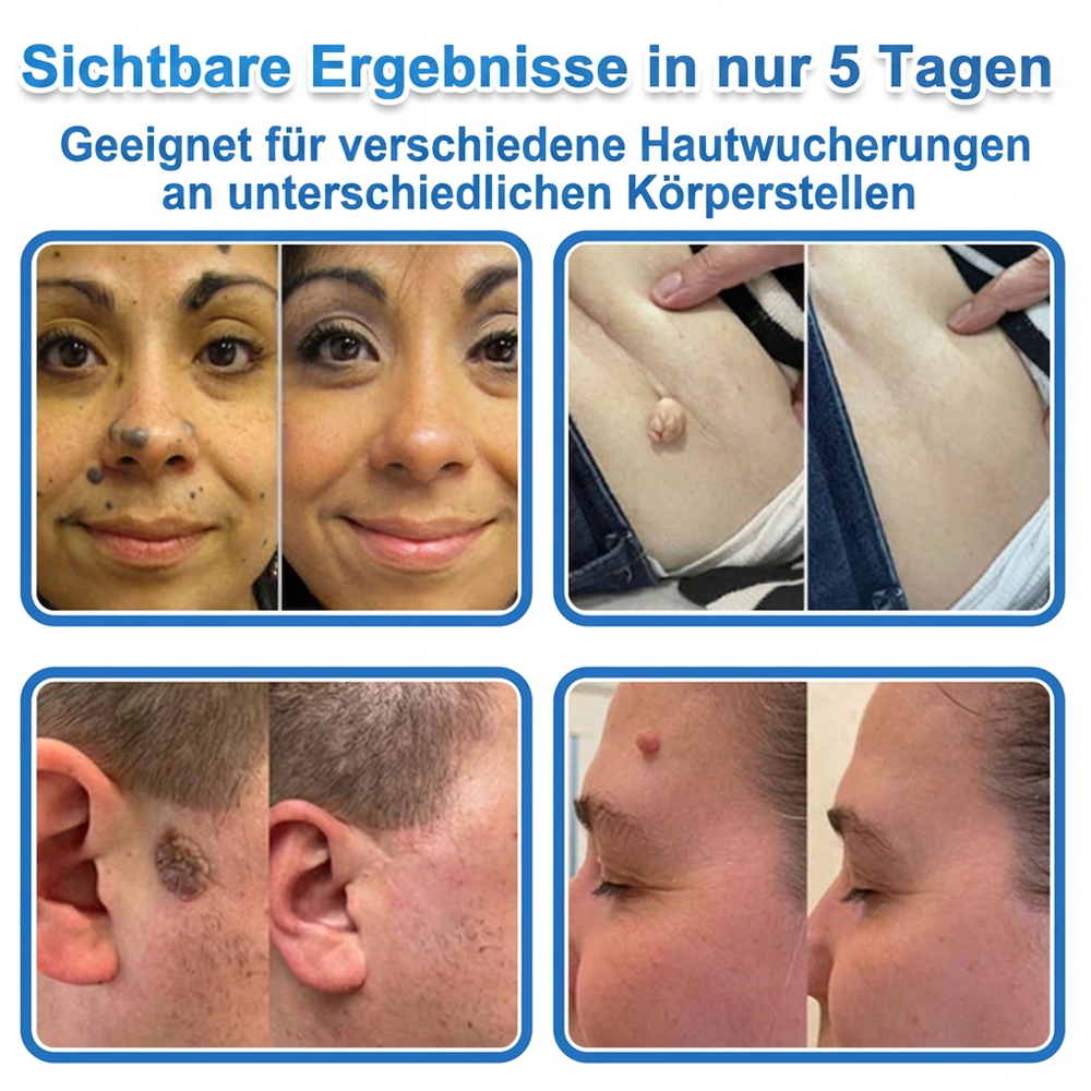 🏆𝑻𝒐𝒑𝑺𝒑𝒊𝒓𝒆® 2-in-1 Mikronadel- & Hydrokolloid-Pflaster | Entferner für erhabene Muttermale, Akne, flache Warzen & Hautanhängsel | Verbessert Falten, Narben & Hautunreinheiten | Unsichtbare Stern-Pickelpflaster für Gesicht & Körper