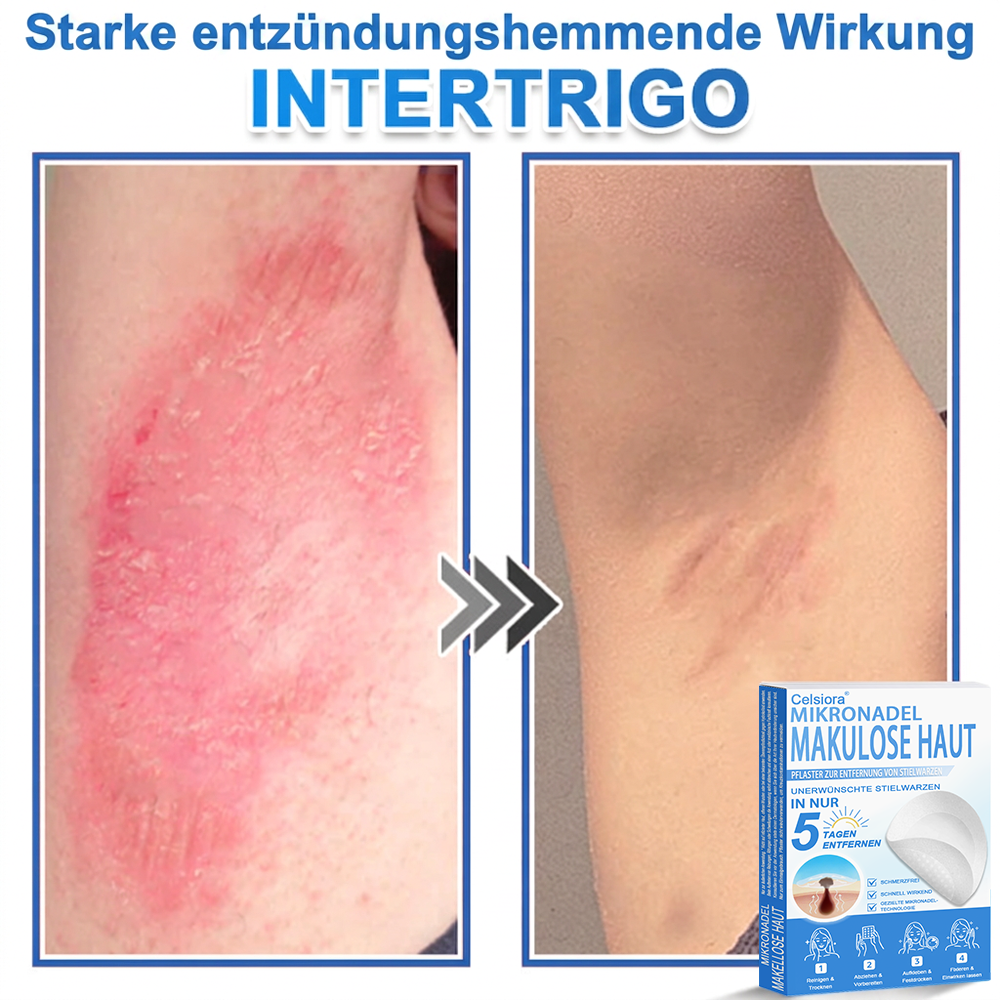 🏆𝑻𝒐𝒑𝑺𝒑𝒊𝒓𝒆® 2-in-1 Mikronadel- & Hydrokolloid-Pflaster | Entferner für erhabene Muttermale, Akne, flache Warzen & Hautanhängsel | Verbessert Falten, Narben & Hautunreinheiten | Unsichtbare Stern-Pickelpflaster für Gesicht & Körper