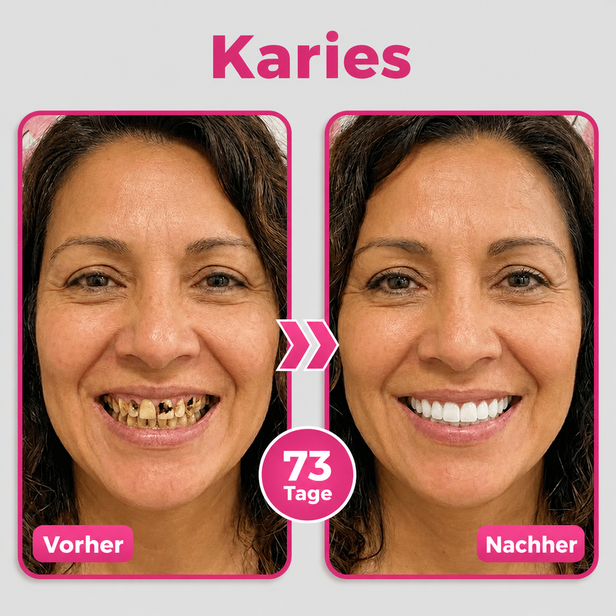 🦷Natravor® Thismile NH-10 Zahnpasta-Serum für Zahnschmelz und Zahnfleisch – Advanced Therapy