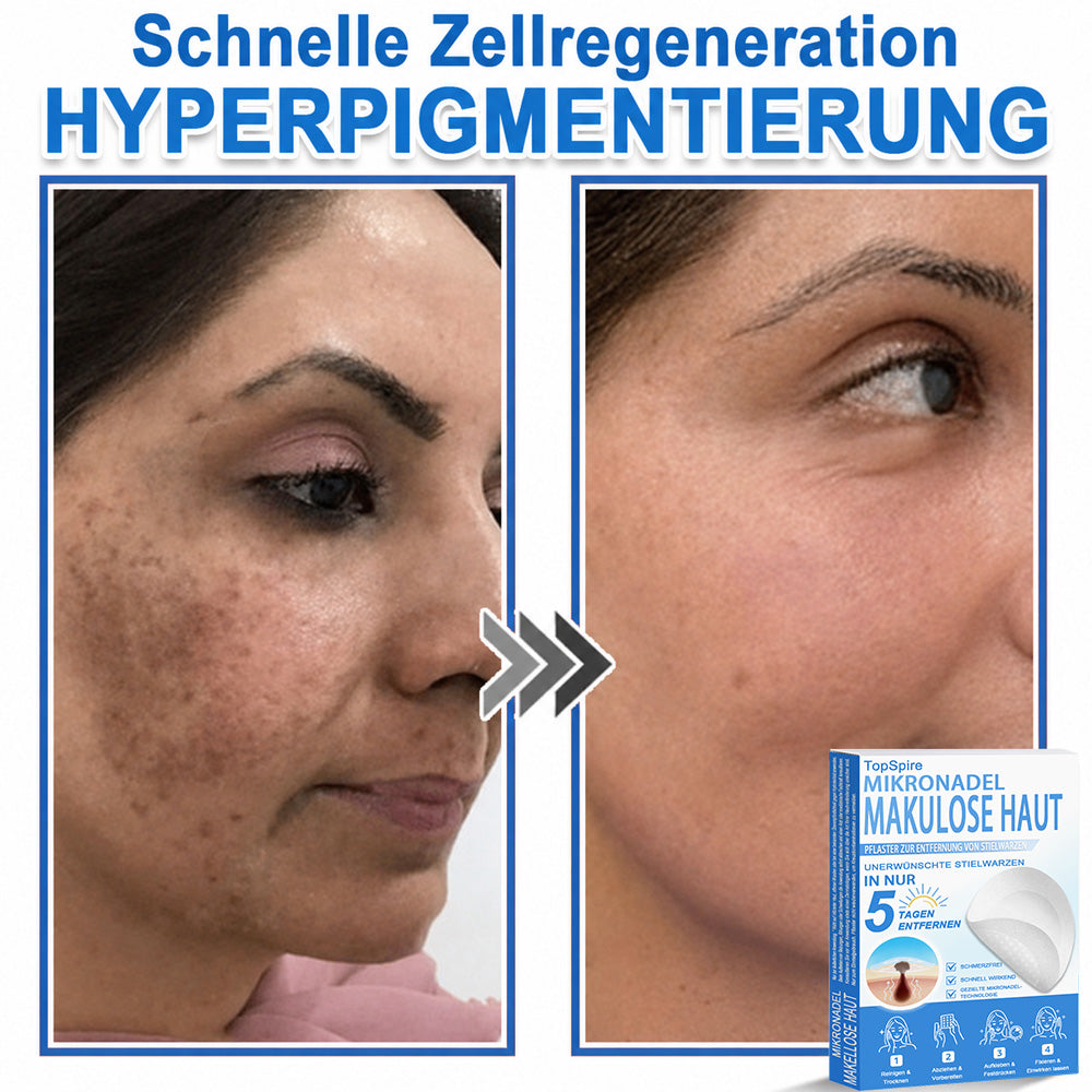 🏆𝑻𝒐𝒑𝑺𝒑𝒊𝒓𝒆® 2-in-1 Mikronadel- & Hydrokolloid-Pflaster | Entferner für erhabene Muttermale, Akne, flache Warzen & Hautanhängsel | Verbessert Falten, Narben & Hautunreinheiten | Unsichtbare Stern-Pickelpflaster für Gesicht & Körper
