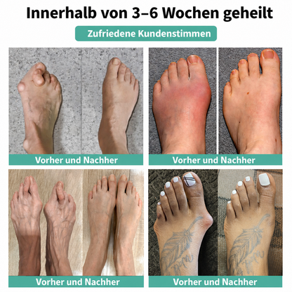 🏅 Natravor® Botanisches Komfort-Pflaster bei Hallux valgus 👠 Flexible Fußpflege + pflanzlich inspirierte Komfortformel b