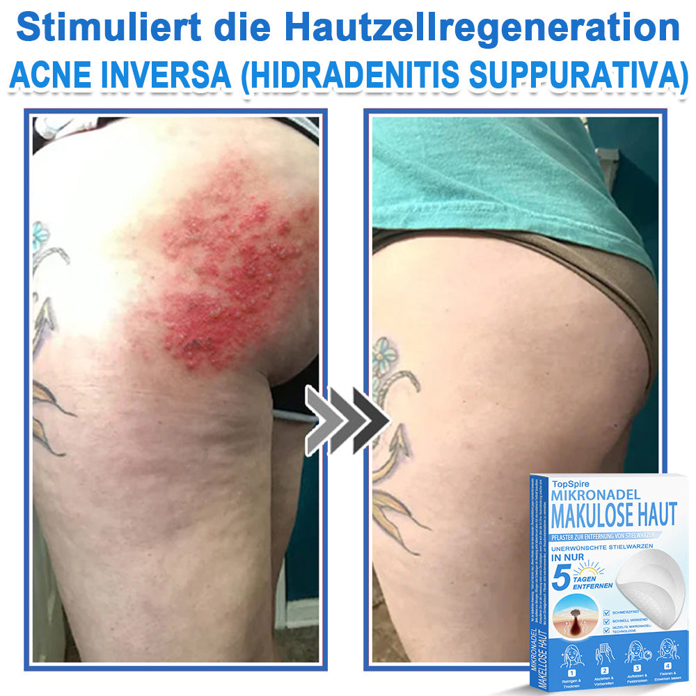 🏆𝑻𝒐𝒑𝑺𝒑𝒊𝒓𝒆® 2-in-1 Mikronadel- & Hydrokolloid-Pflaster | Entferner für erhabene Muttermale, Akne, flache Warzen & Hautanhängsel | Verbessert Falten, Narben & Hautunreinheiten | Unsichtbare Stern-Pickelpflaster für Gesicht & Körper