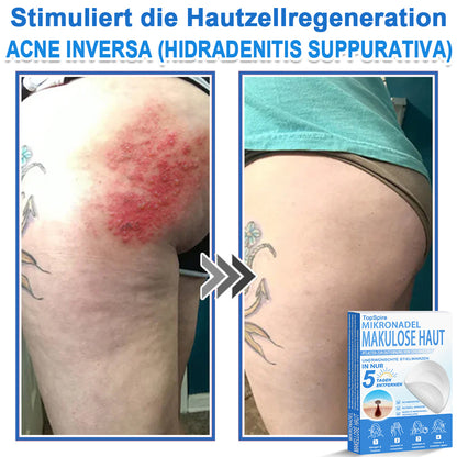 🏆𝑻𝒐𝒑𝑺𝒑𝒊𝒓𝒆® 2-in-1 Mikronadel- & Hydrokolloid-Pflaster | Entferner für erhabene Muttermale, Akne, flache Warzen & Hautanhängsel | Verbessert Falten, Narben & Hautunreinheiten | Unsichtbare Stern-Pickelpflaster für Gesicht & Körper
