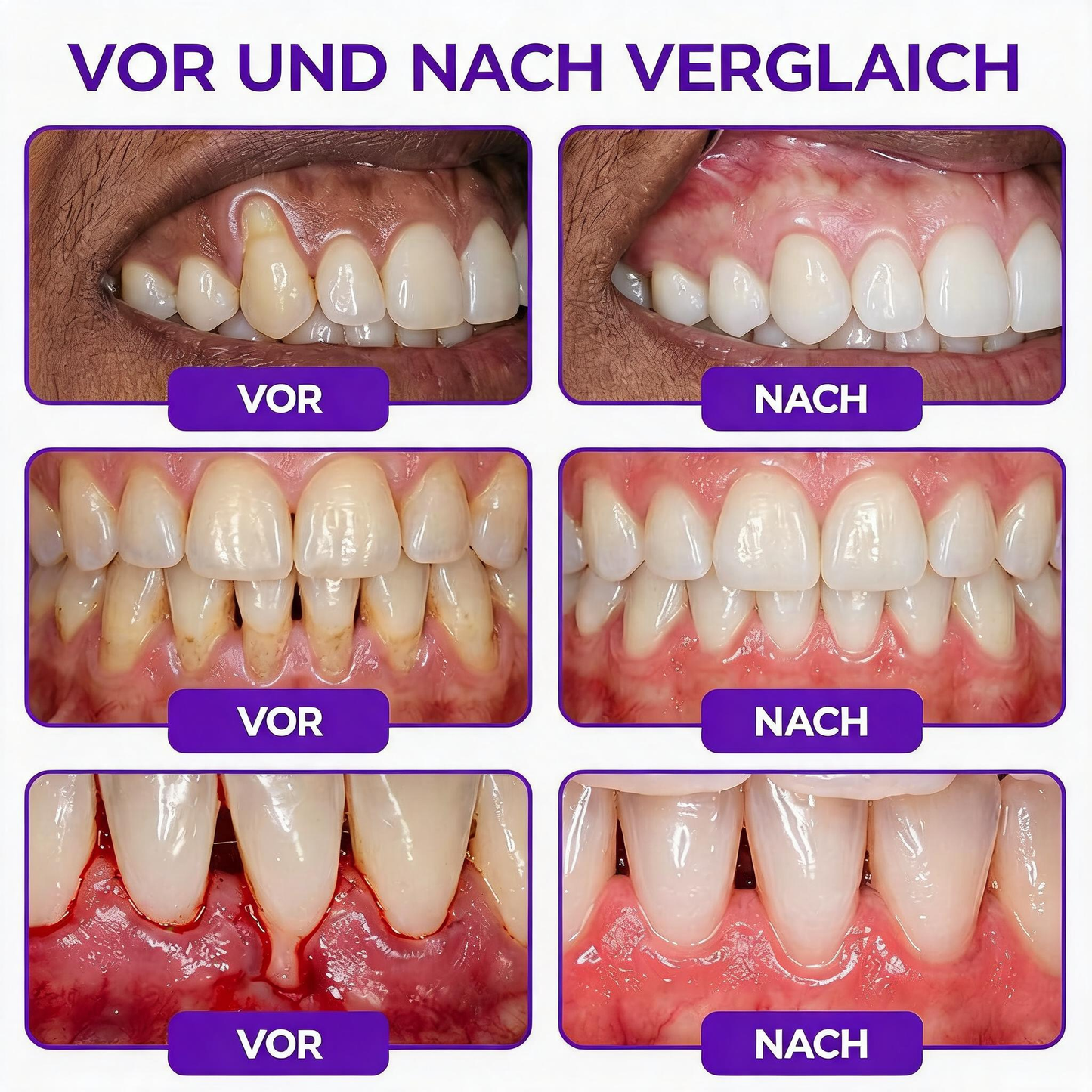 𝐍𝐚𝐭𝐫𝐚𝐯𝐨𝐫® VioCore Zahnpasta zur Behandlung von Zahnfleischentzündungen und Parodontitis mit Bienengift
